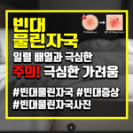 빈대 물린자국