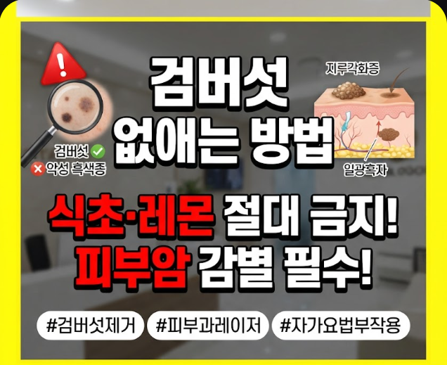 검버섯 없애는 방법