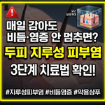 두피 지루성 피부염 치료